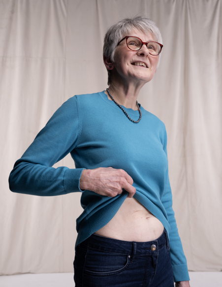 Living kidney donor Sarah smiling and lifting her top to show her kidney donation scar