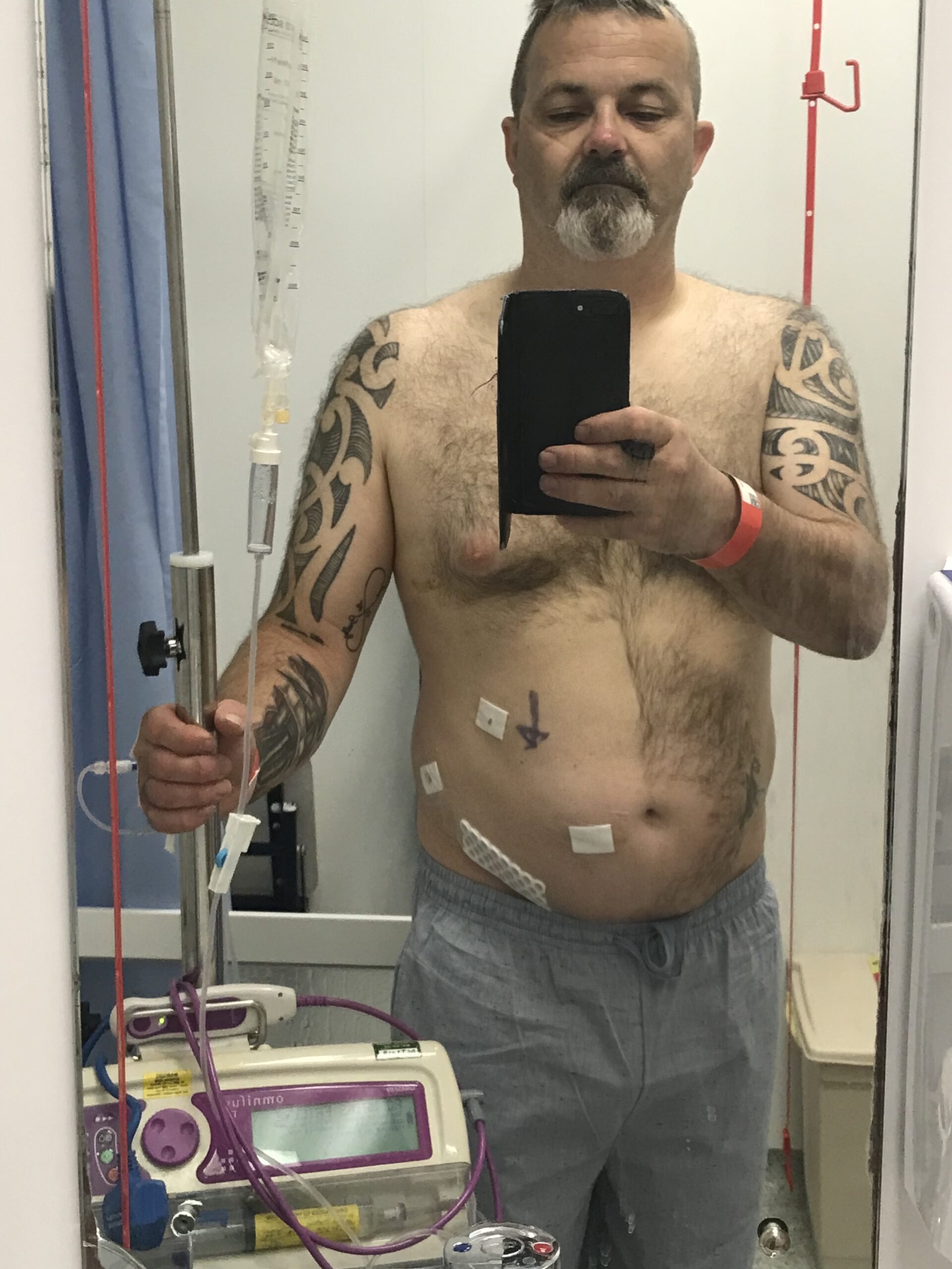 Non-directed living kidney donor David