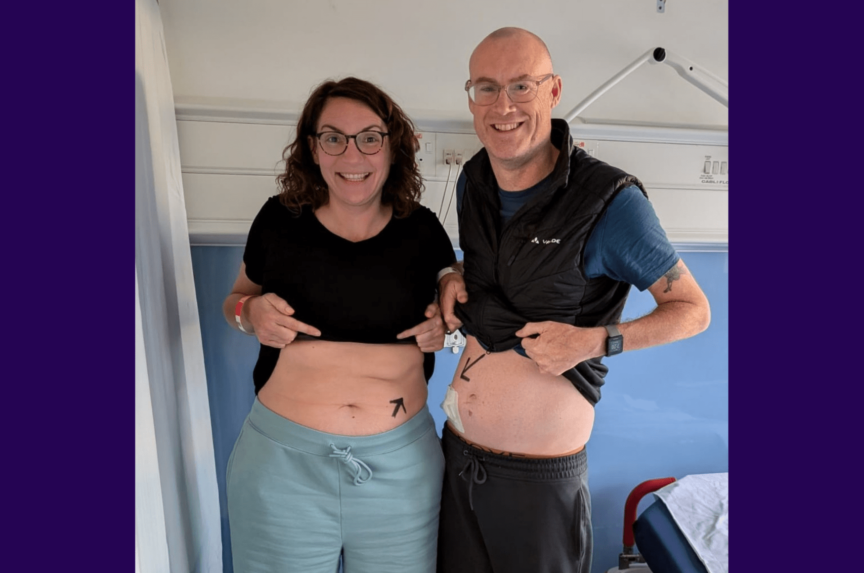Living kidney donor Stephanie standing next to her husband and kidney recipient. They are both lifting up their tops to show the area around their kidneys, and have arrows drawn on their skin in black sharpie pointing towards their kidney. Stephanie's husband has a bandage over the area. They are both smiling widely for the camera.